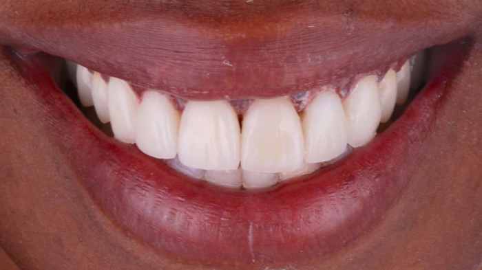 Smile Turkey porcelain veneer packages for a stunning smile